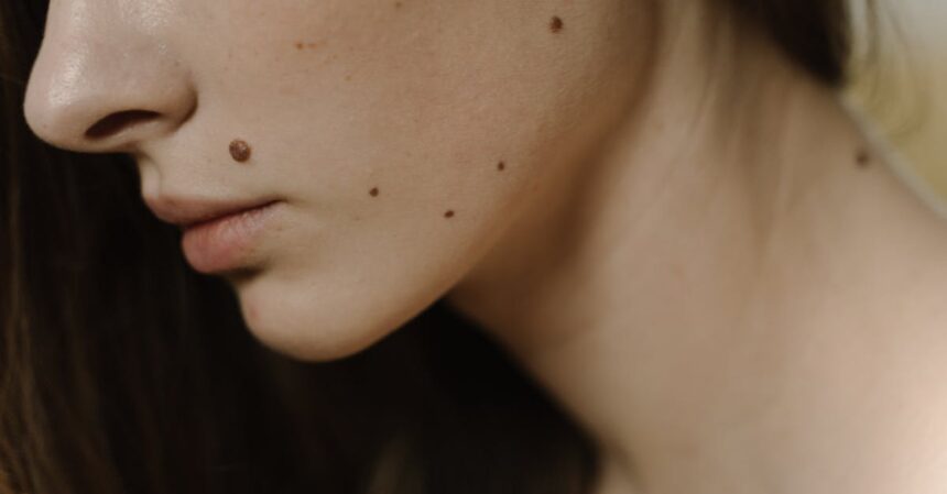découvrez tout sur les moles : définition, types, causes, prévention et traitements. apprenez à reconnaître les signes d'alerte et l'importance des contrôles dermatologiques pour une peau en santé.